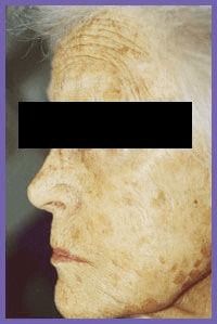 PRP Microneedling Before & After
