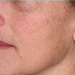 PRP Microneedling Before & After