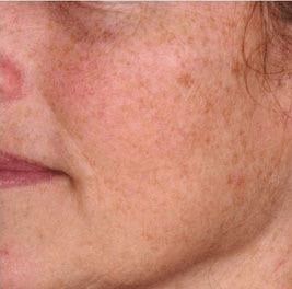 PRP Microneedling Before & After