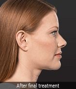 Non-Surgical Fat Removal Before & After