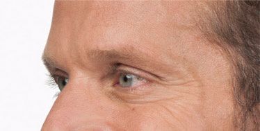 Botox® Cosmetic Before & After