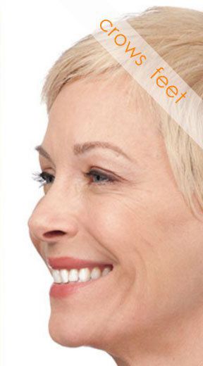 Botox® Cosmetic Before & After