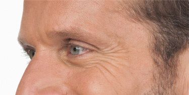 Botox® Cosmetic Before & After