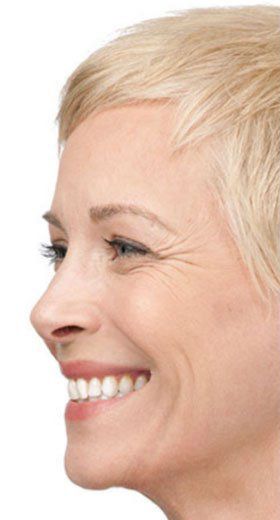 Botox® Cosmetic Before & After