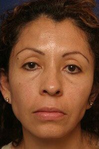 Vampire Facelift® Before & After