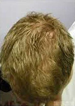 Hair Regrowth Treatment Before & After