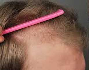 Hair Regrowth Treatment Before & After