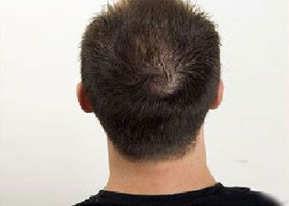 Hair Regrowth Treatment Before & After