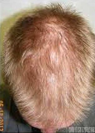 Hair Regrowth Treatment Before & After