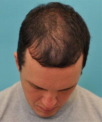 PRF Hair Regrowth Before & After