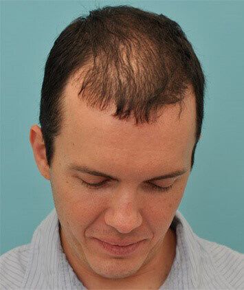 PRF Hair Regrowth Before & After
