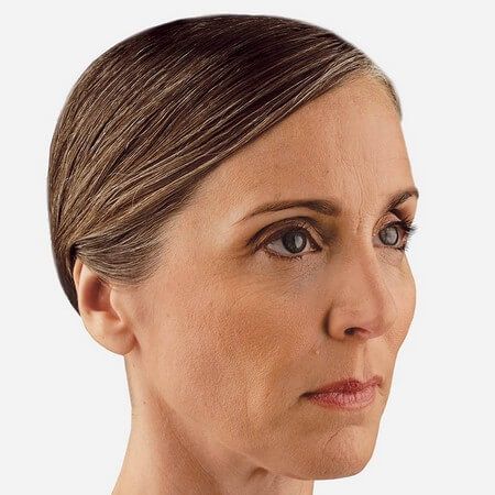 Voluma™ Before & After