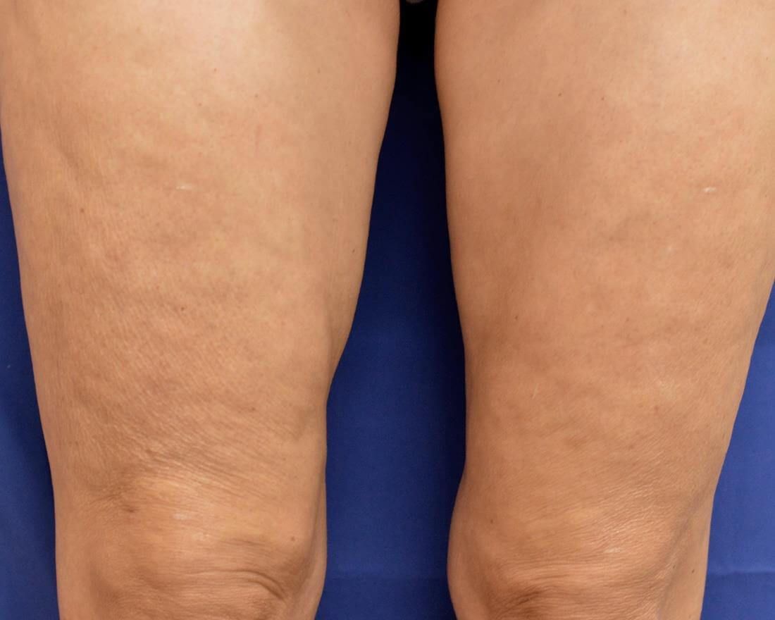 RF Microneedling Before & After