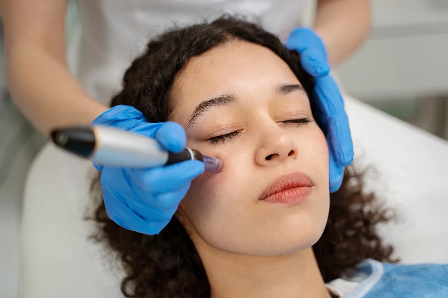 Roswell microneedling model receiving treatment 