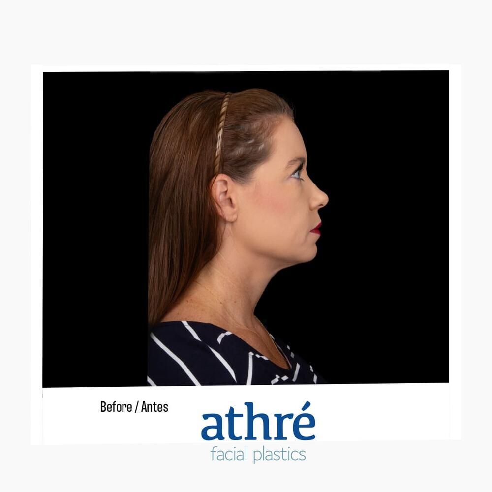 Skin Resurfacing Before & After