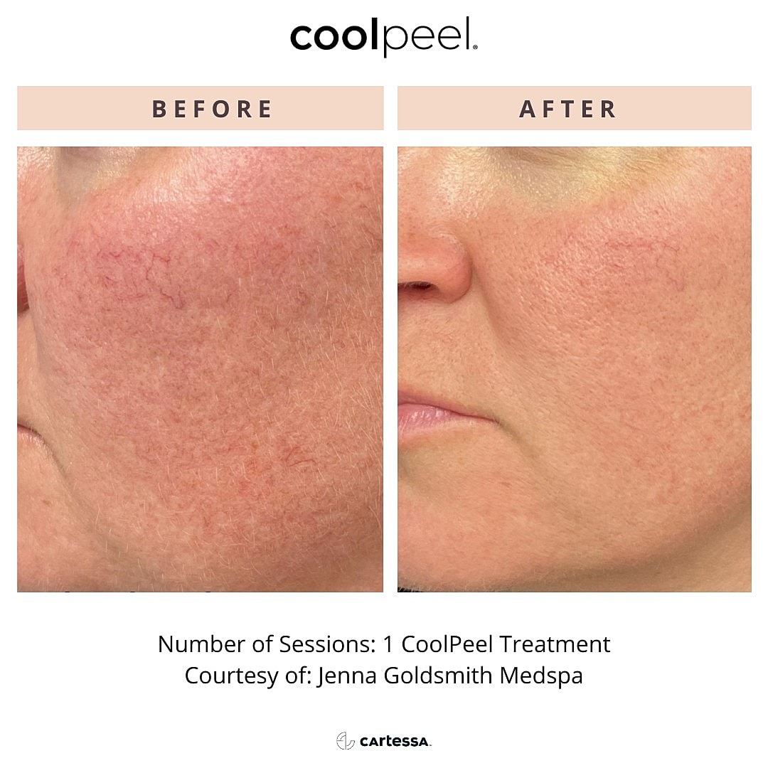 CoolPeel Before & After