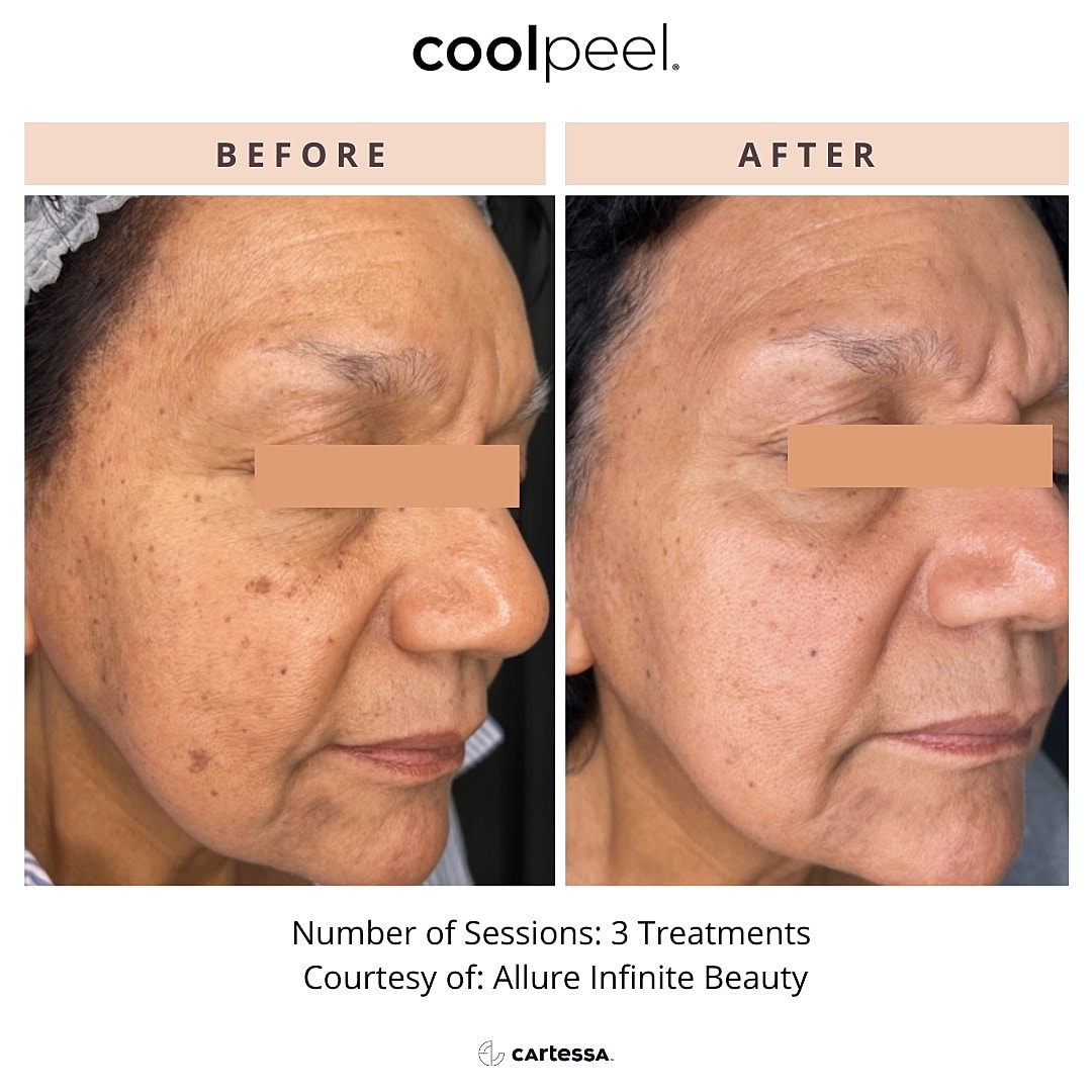 CoolPeel Before & After