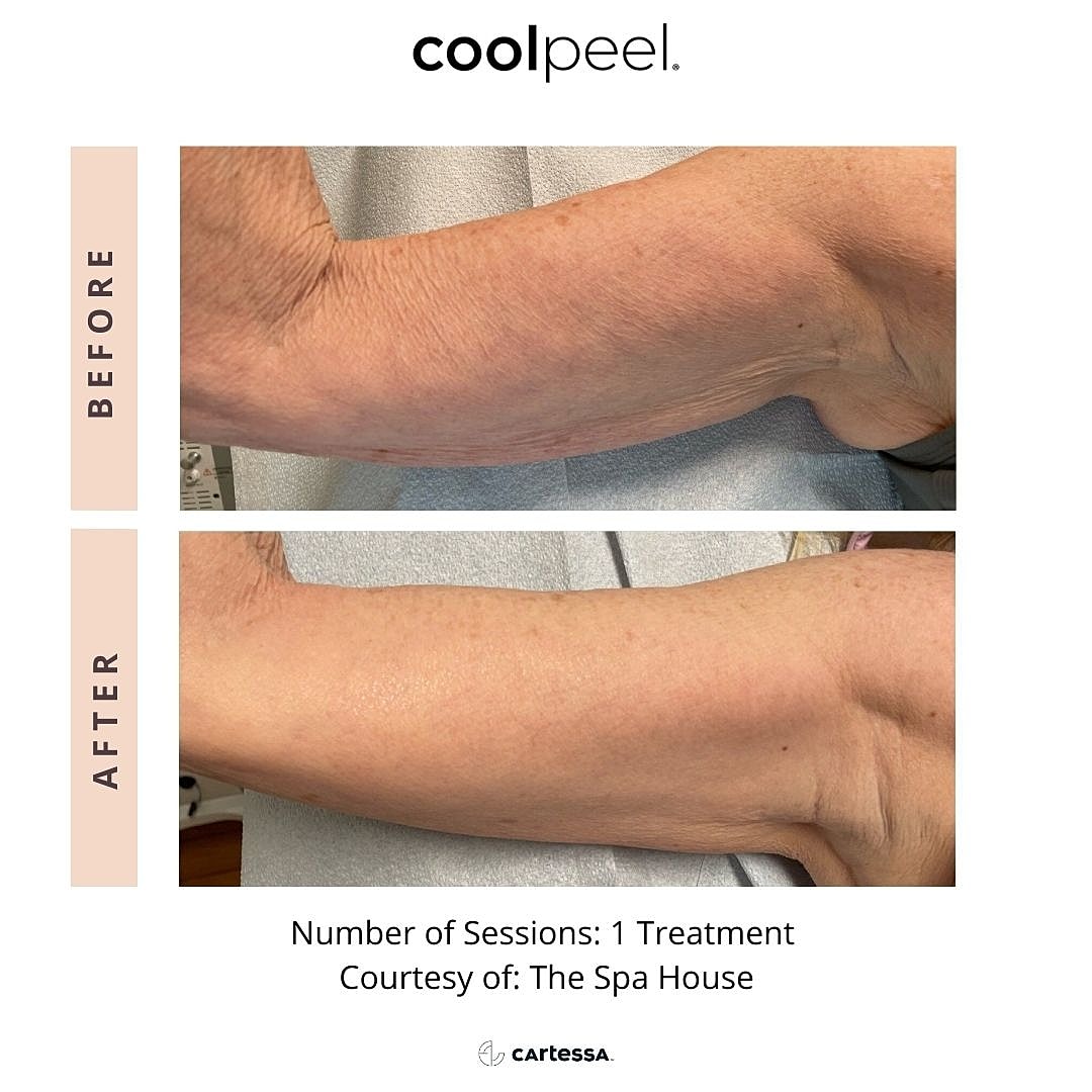 CoolPeel Before & After