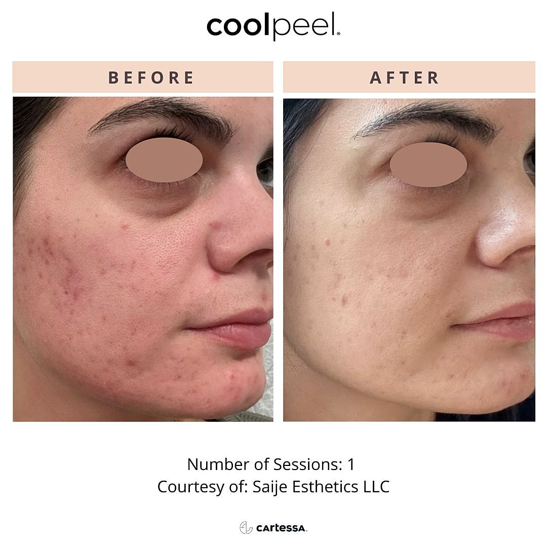 CoolPeel Before & After