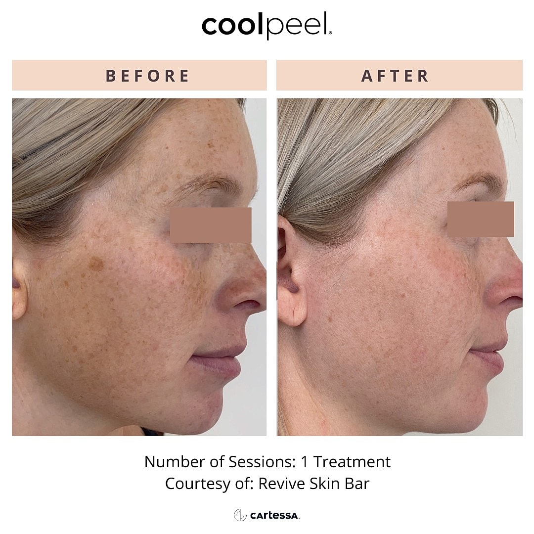 CoolPeel Before & After