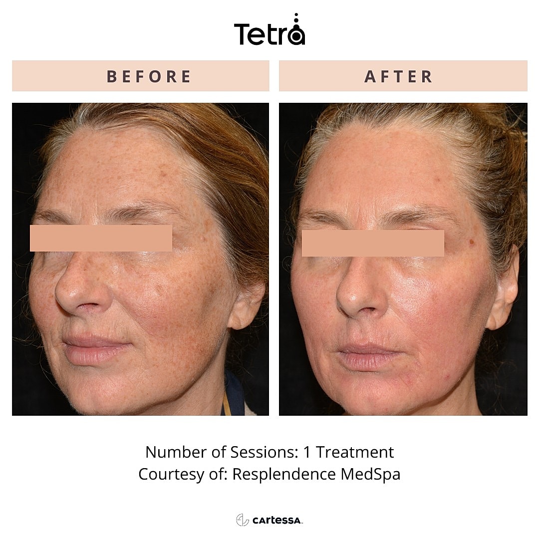 CoolPeel Before & After