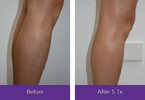  Before & After