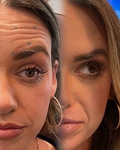 Botox Before & After