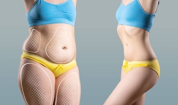 Liposuction In Nairobi 