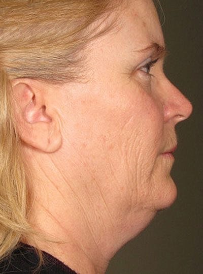 Ultherapy Before & After