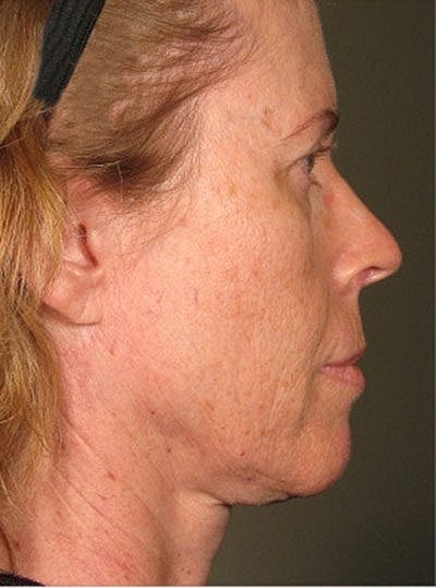Ultherapy Before & After