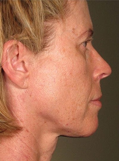 Ultherapy Before & After