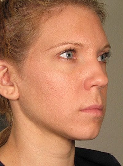 Ultherapy Before & After