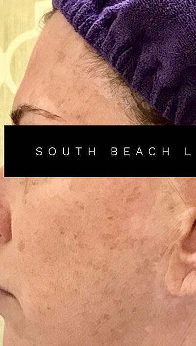 Laser Before & After