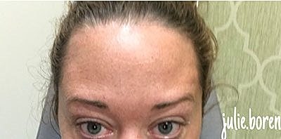 Botox After Photo
