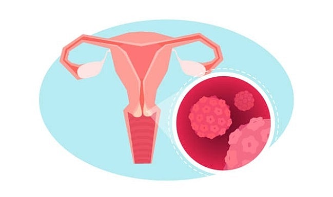 Dr. Lee and Dr. Manuel discuss ovarian cancer.