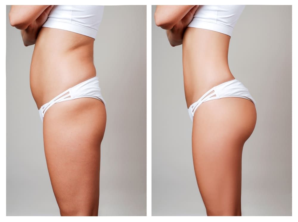 a before and after diagram of a female patient with a BBL