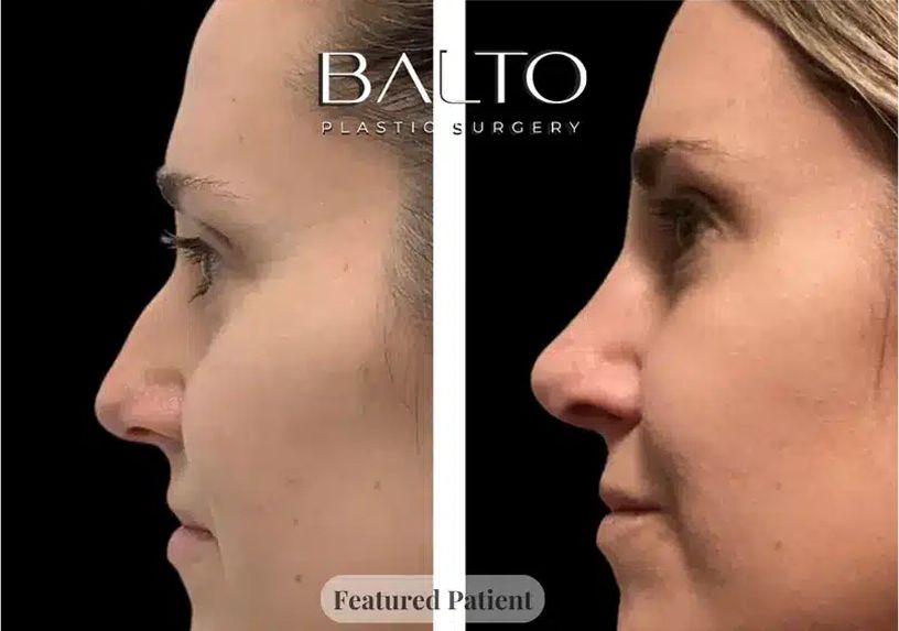 Rhinoplasty Before & After