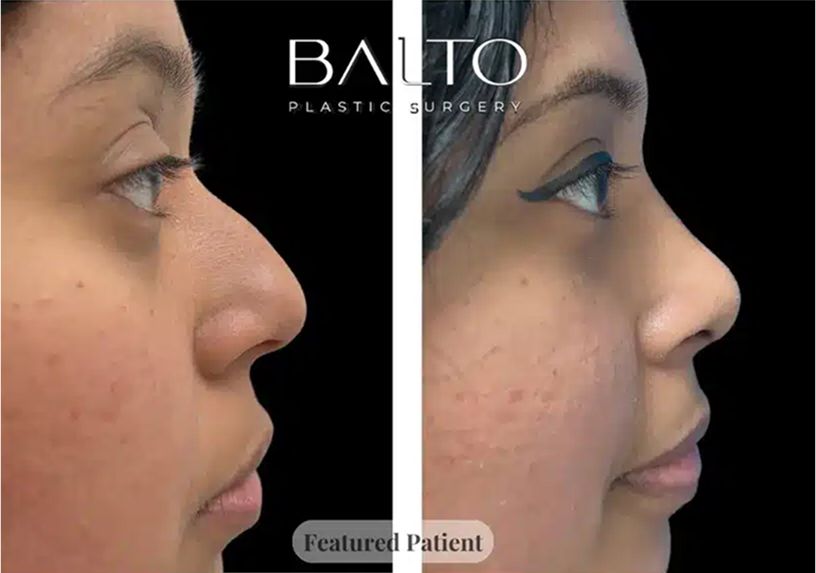 Rhinoplasty Before & After