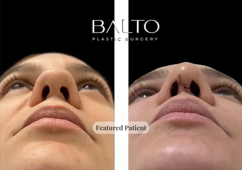 Rhinoplasty Before & After