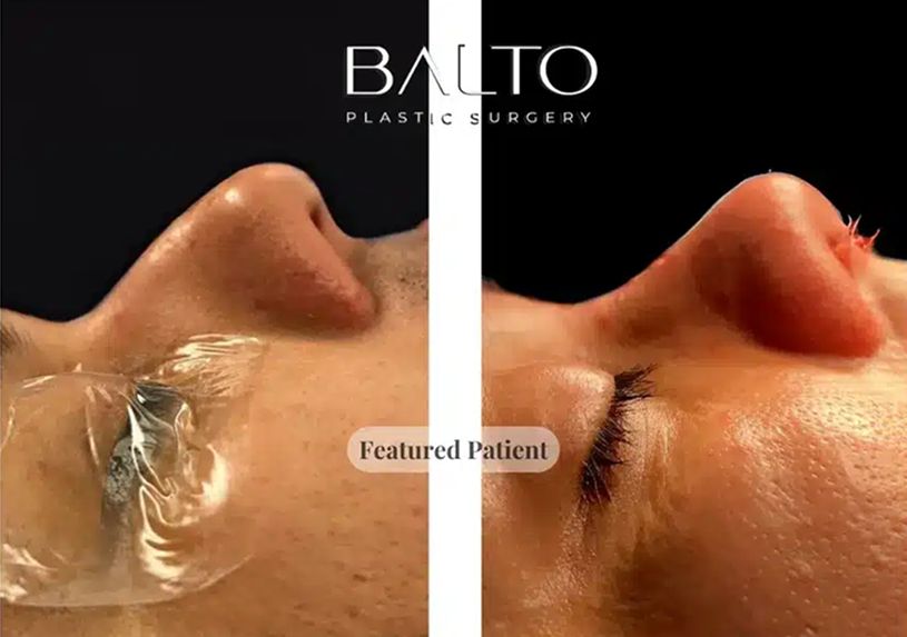 Rhinoplasty Before & After