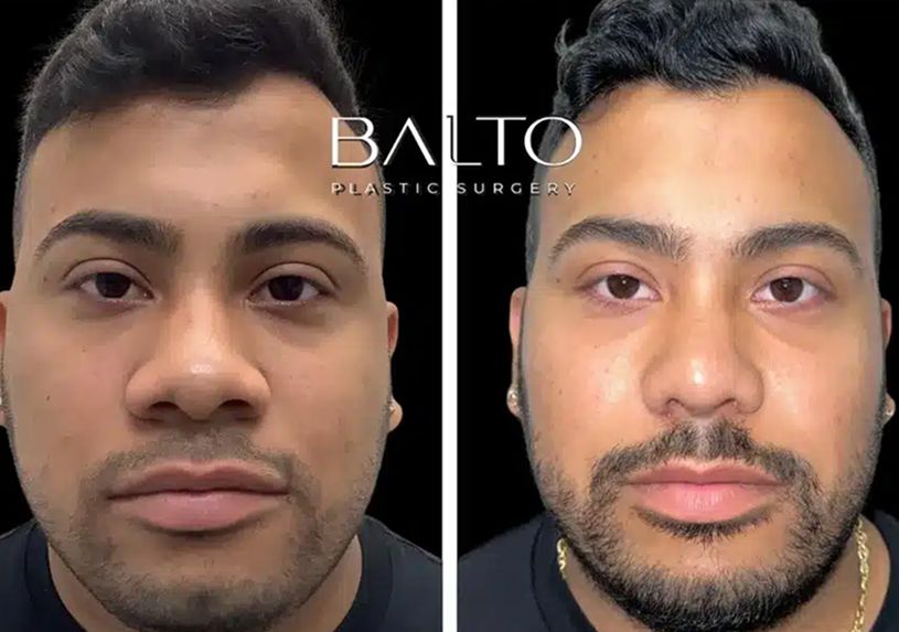 Rhinoplasty Before & After