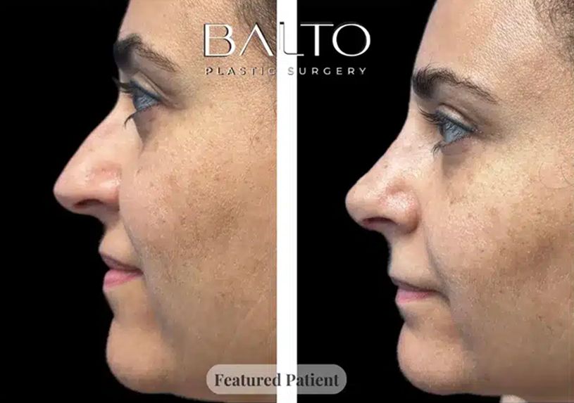 Rhinoplasty Before & After