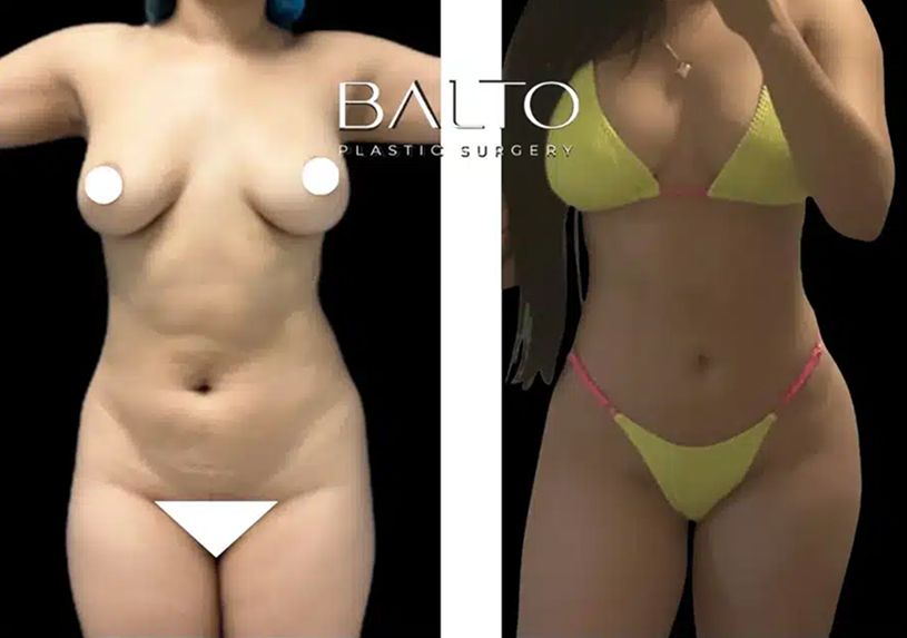 Liposuction Before & After
