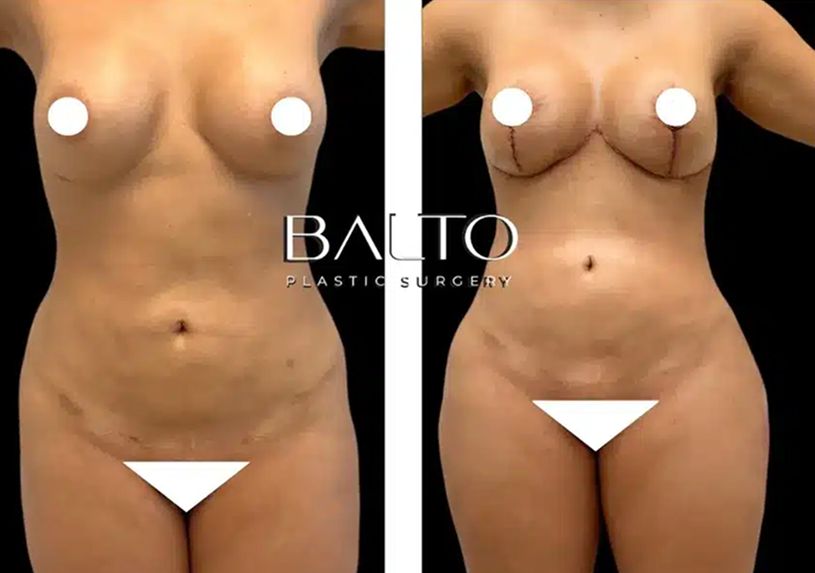 Liposuction Before & After