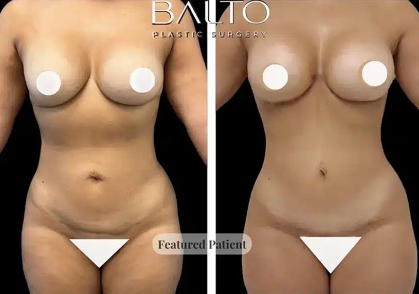 Liposuction Before & After