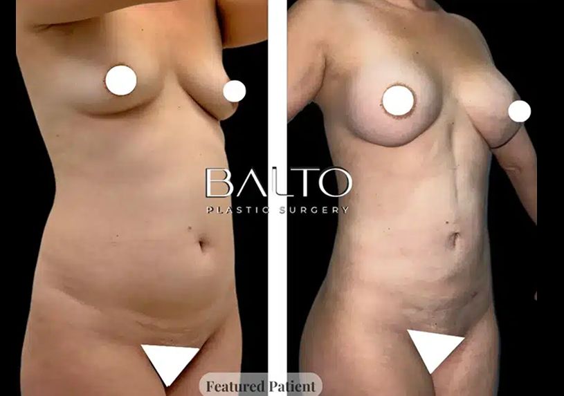 Liposuction Before & After