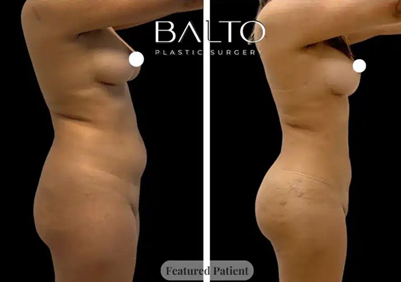Liposuction Before & After