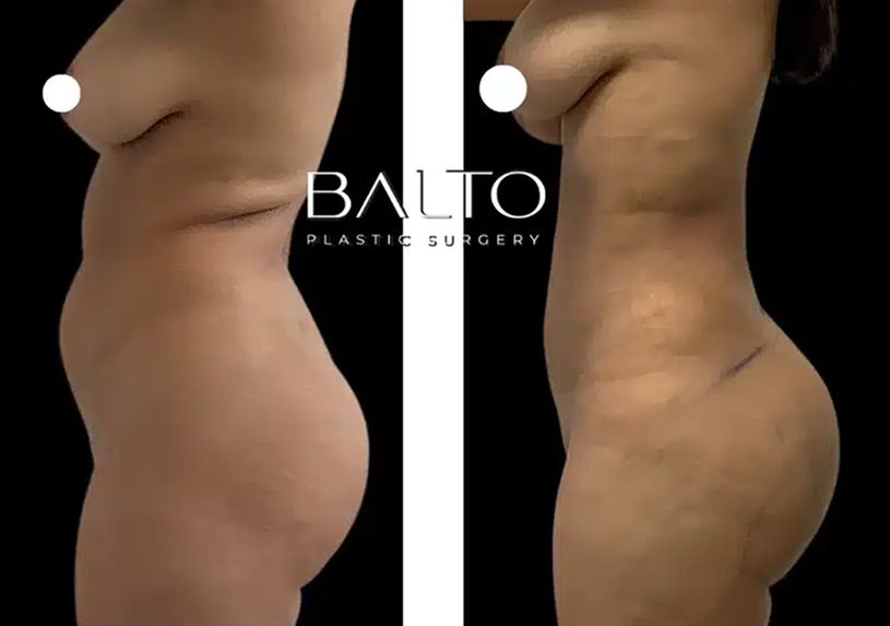 Liposuction Before & After