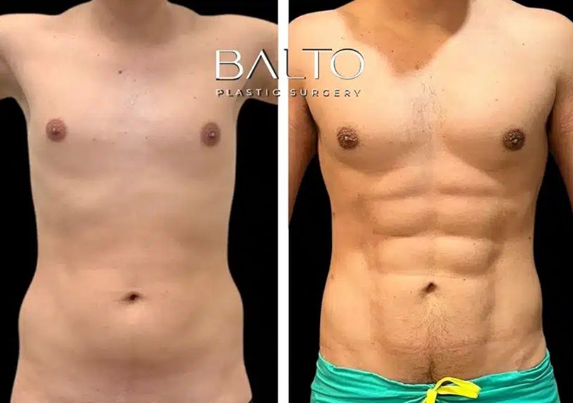Male Liposuction Before & After