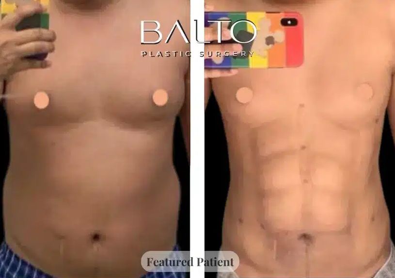 Male Liposuction Before & After